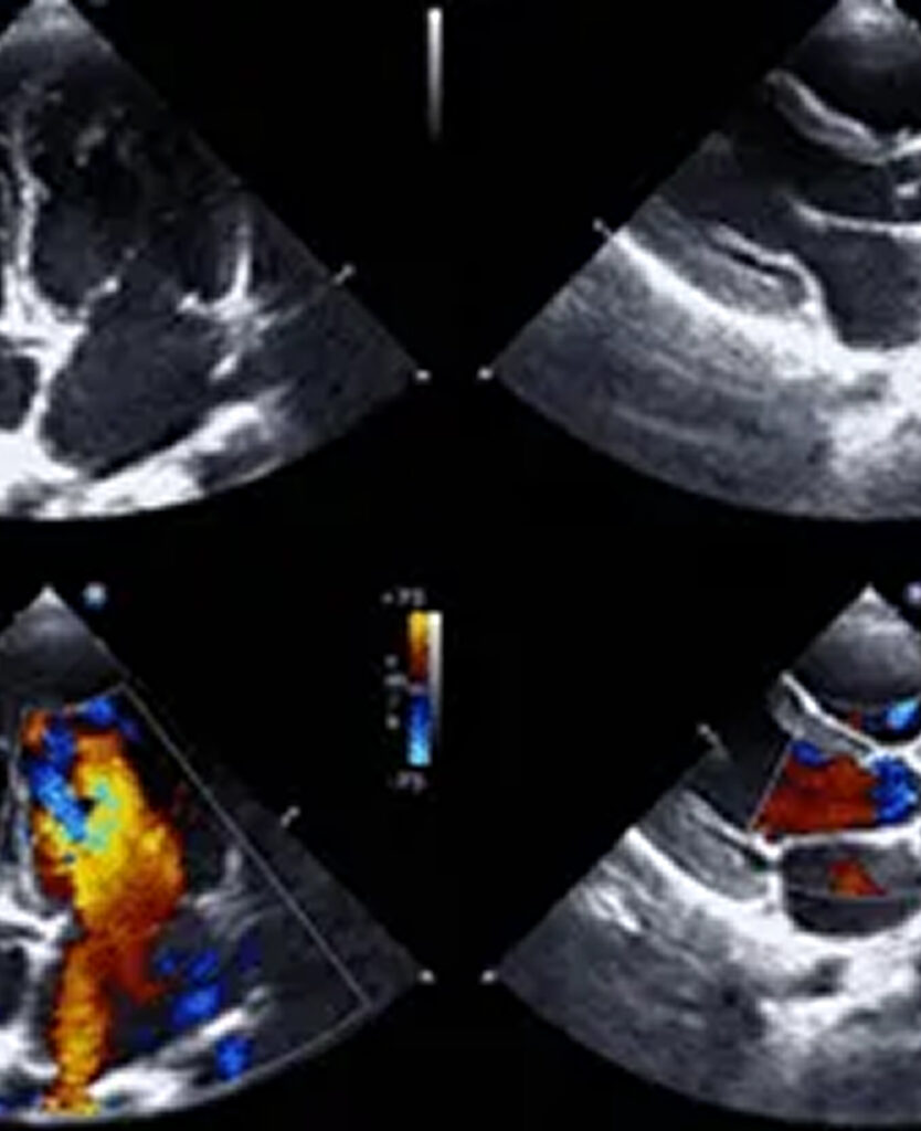 Valvular Heart Disease